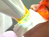 Baton Rouge Zoom whitening - step three