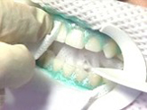 Baton Rouge Zoom whitening - step two