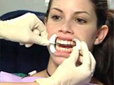 Baton Rouge Zoom whitening - step one