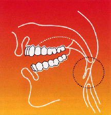 Baton Rouge stop snoring - before appliance