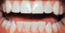 After - Baton Rouge teeth whitening