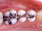 Before Baton Rouge mercury-free fillings