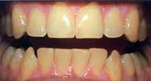 Before - Baton Rouge teeth whitening