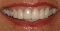 Baton Rouge porcelain crowns - after