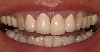 Baton Rouge porcelain crowns - before