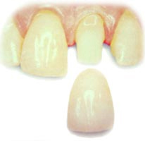 Baton Rouge porcelain crowns