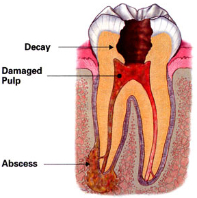 Baton Rouge root canal treatment